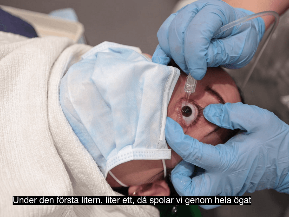 En patient med munskydd och handduk under hakan. Vårdpersonal med blåa handskar som spolar ett öga. 